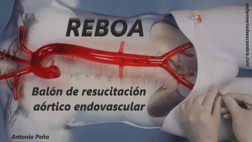 REBOA Balón de resucitación aórtico endovascular
Resuscitative Endovascular Balloon Occlusion of the Aorta